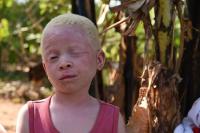 Albino (Albinizm) Hastalığı Genetiği