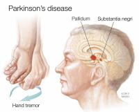 Parkinson Hastalığının Genetik Yönü Varmıdır?