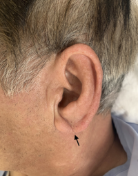  Kulaklarda Franks işaretinin akut aort diseksiyon bağlantısı var mı?