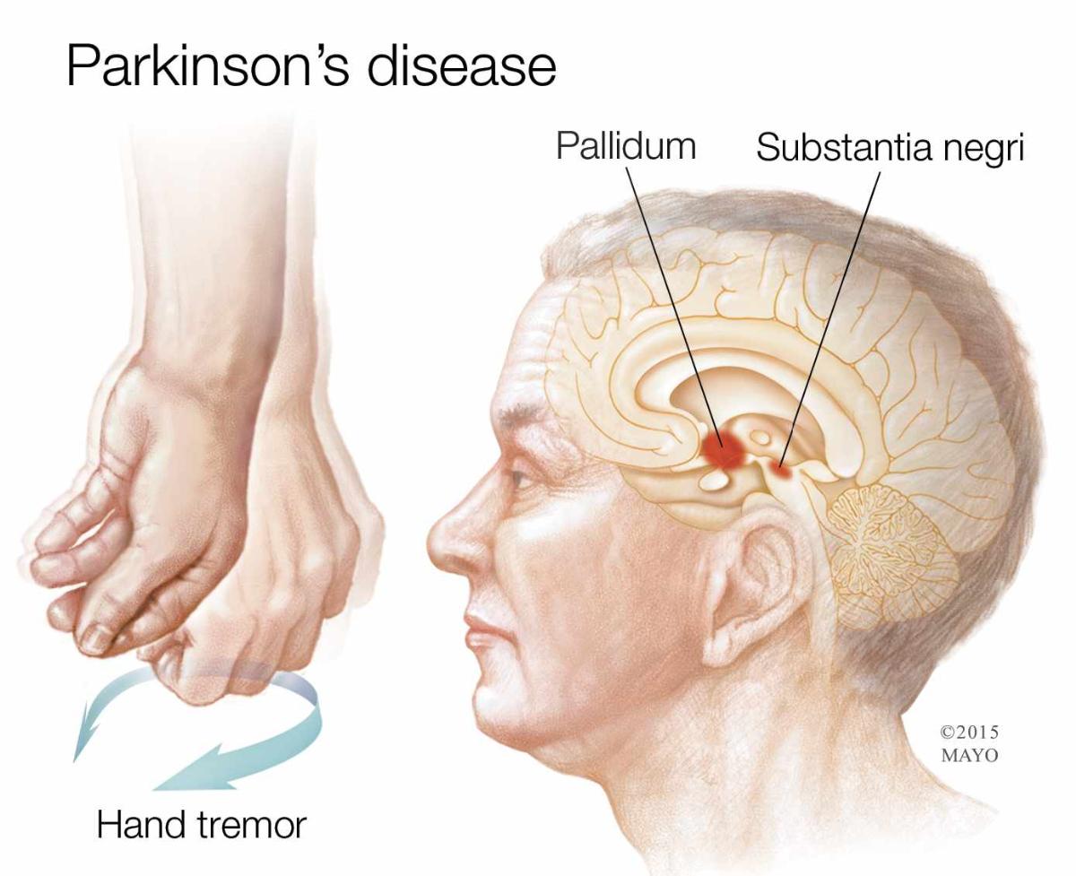 Prof Dr Haydar BaĞiŞ Parkinson Hastalığının Genetik Yönü Varmıdır