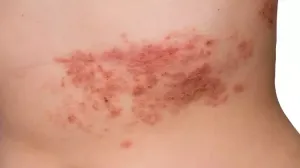 Zona Aşısı Kalp Hastalığı Riskini Azaltıyor
